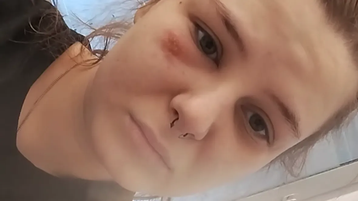 Calantha Wollny sieht übel aus: Sie sitzt mit Gürtelrose im Gesicht im Krankenhaus Calantha Wollny sieht übel aus: Sie sitzt mit Gürtelrose im Gesicht im Krankenhaus