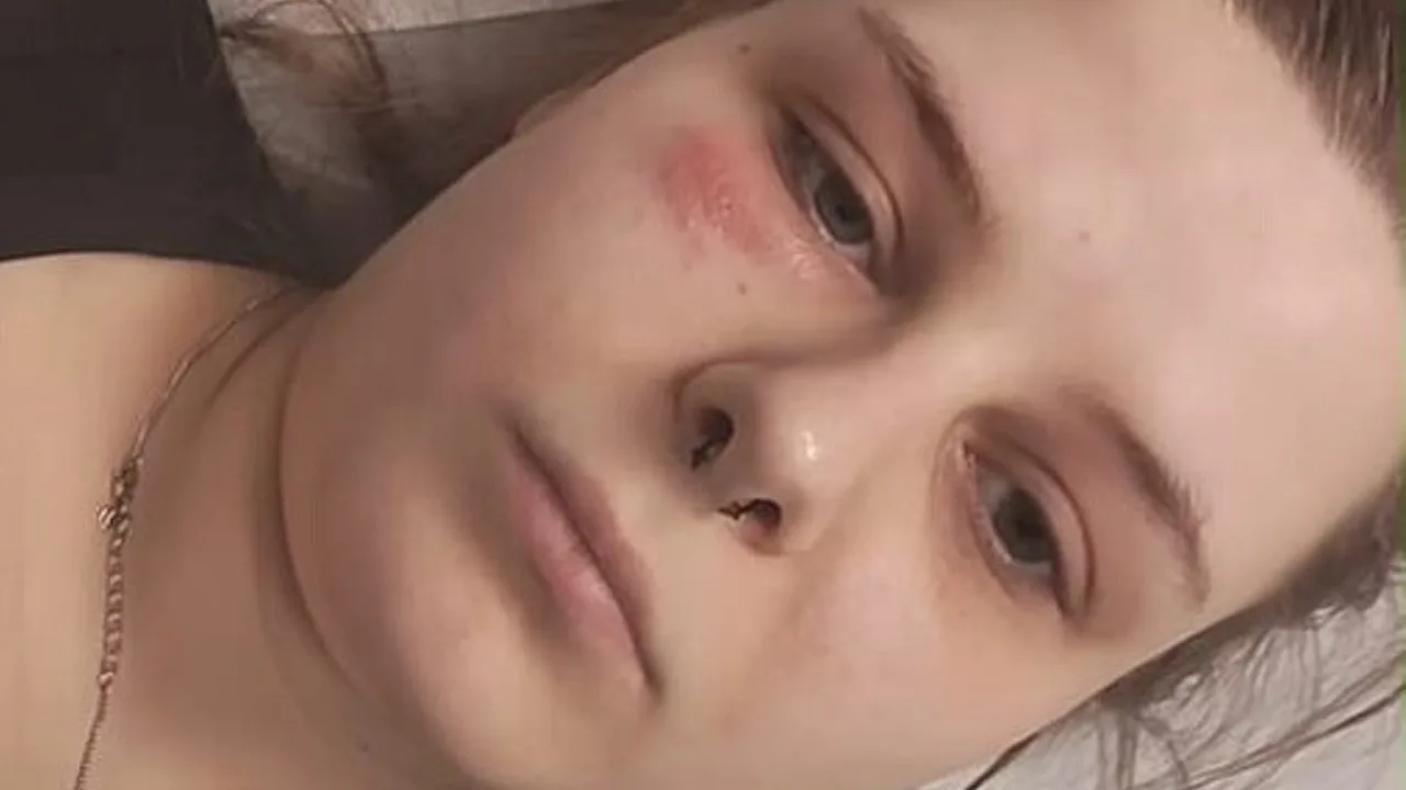 Calantha Wollny ist im Krankenhaus Calantha Wollny liegt mit Gürtelrose unter dem Auge im Krankenhausbett - Foto: Instagram/Randale_caly