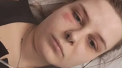 Calantha Wollny liegt mit Gürtelrose unter dem Auge im Krankenhausbett