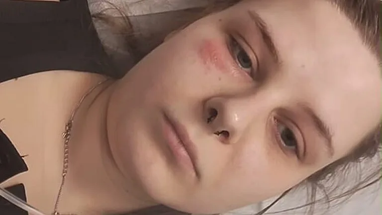Calantha Wollny liegt mit Gürtelrose unter dem Auge im Krankenhausbett