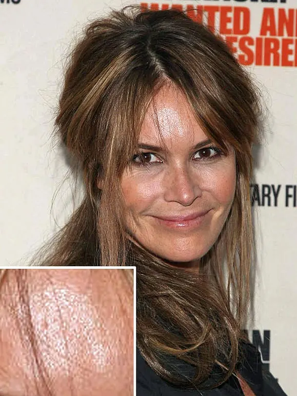 Von wegen zarter Teint! Diese Stars kämpfen mit Pickeln, Pusteln und Fettglanz - Bild 5