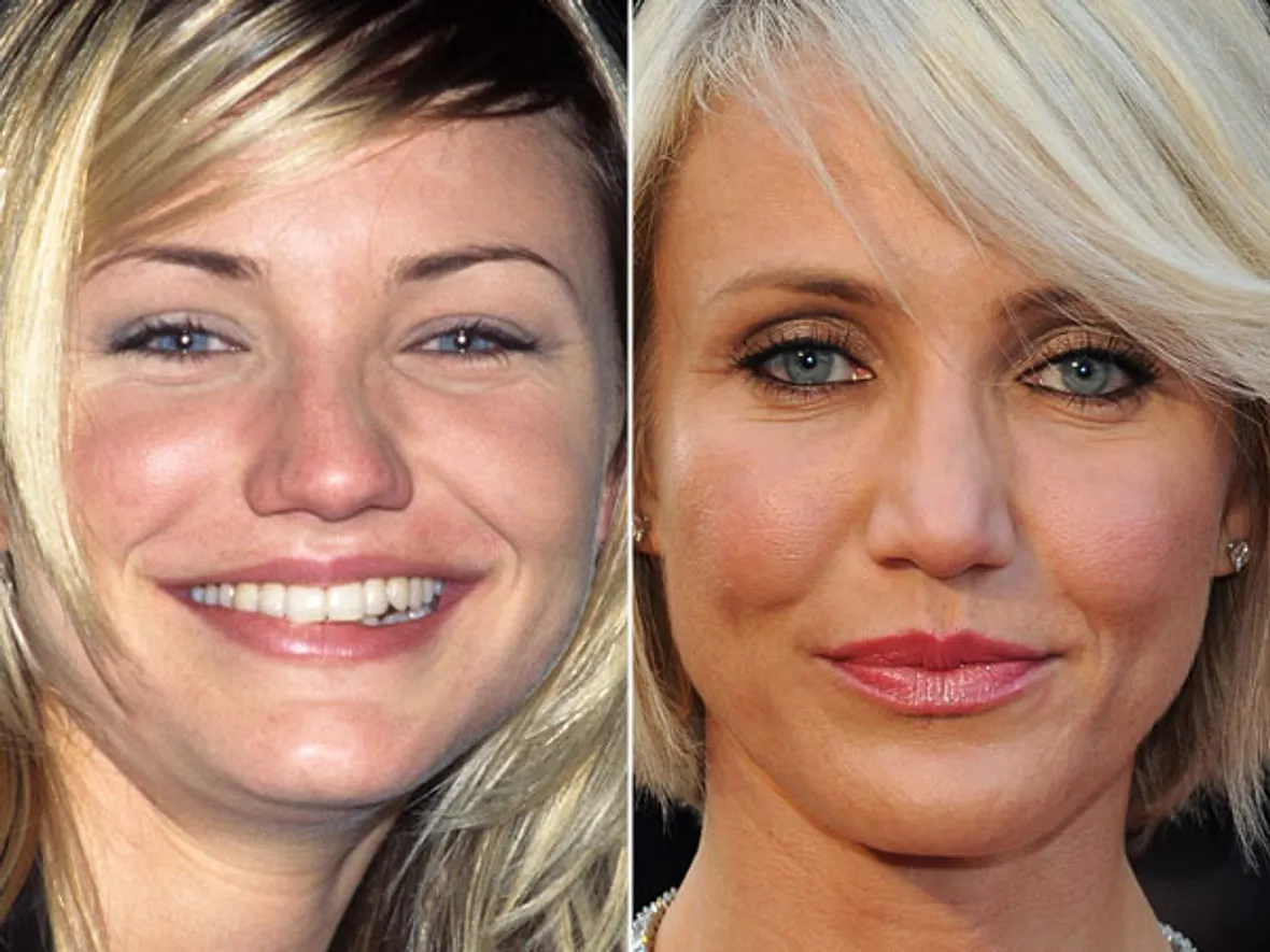 Cameron Diaz Nasen-OP? Ja, bitte! Stars im Vorher-Nachher-Vergleich