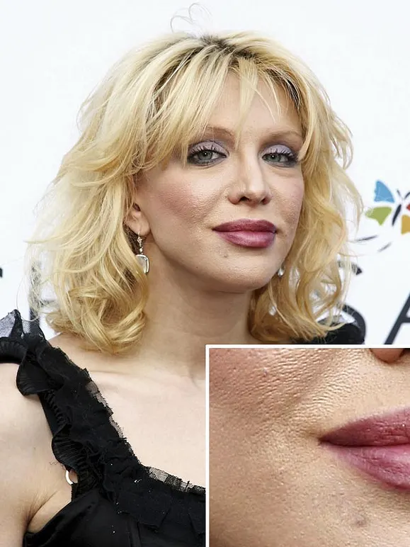 Von wegen zarter Teint! Diese Stars kämpfen mit Pickeln, Pusteln und Fettglanz - Bild 8