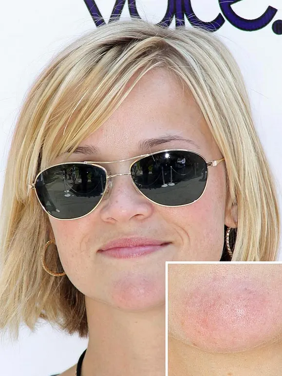 Von wegen zarter Teint! Diese Stars kämpfen mit Pickeln, Pusteln und Fettglanz - Bild 6