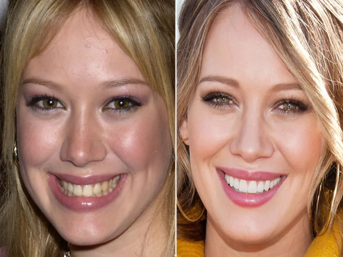 Hilary Duff Nasen-OP? Ja, bitte! Stars im Vorher-Nachher-Vergleich