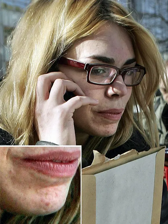 Von wegen zarter Teint! Diese Stars kämpfen mit Pickeln, Pusteln und Fettglanz - Bild 10