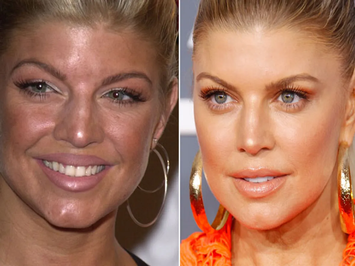 Fergie Nasen-OP? Ja, bitte! Stars im Vorher-Nachher-Vergleich