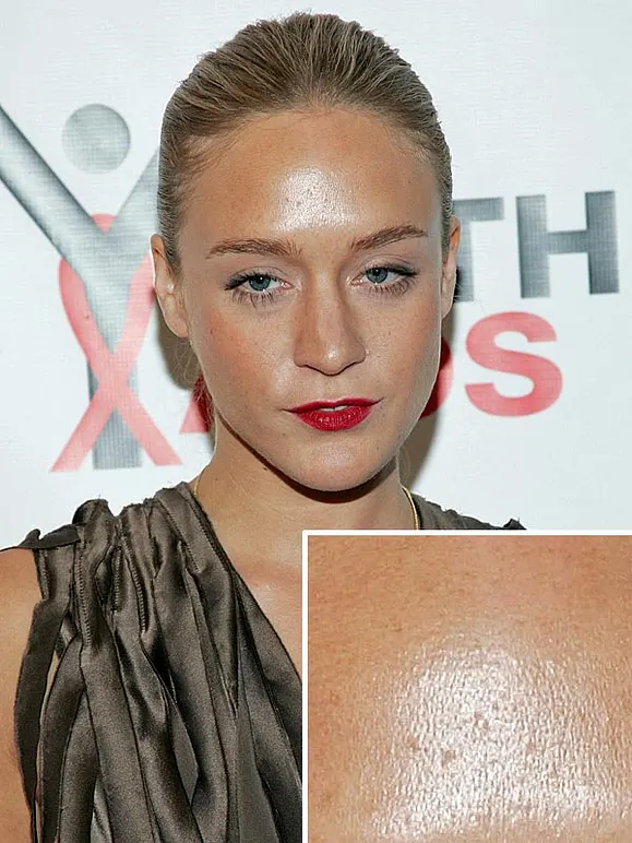 Von wegen zarter Teint! Diese Stars kämpfen mit Pickeln, Pusteln und Fettglanz - Bild 11