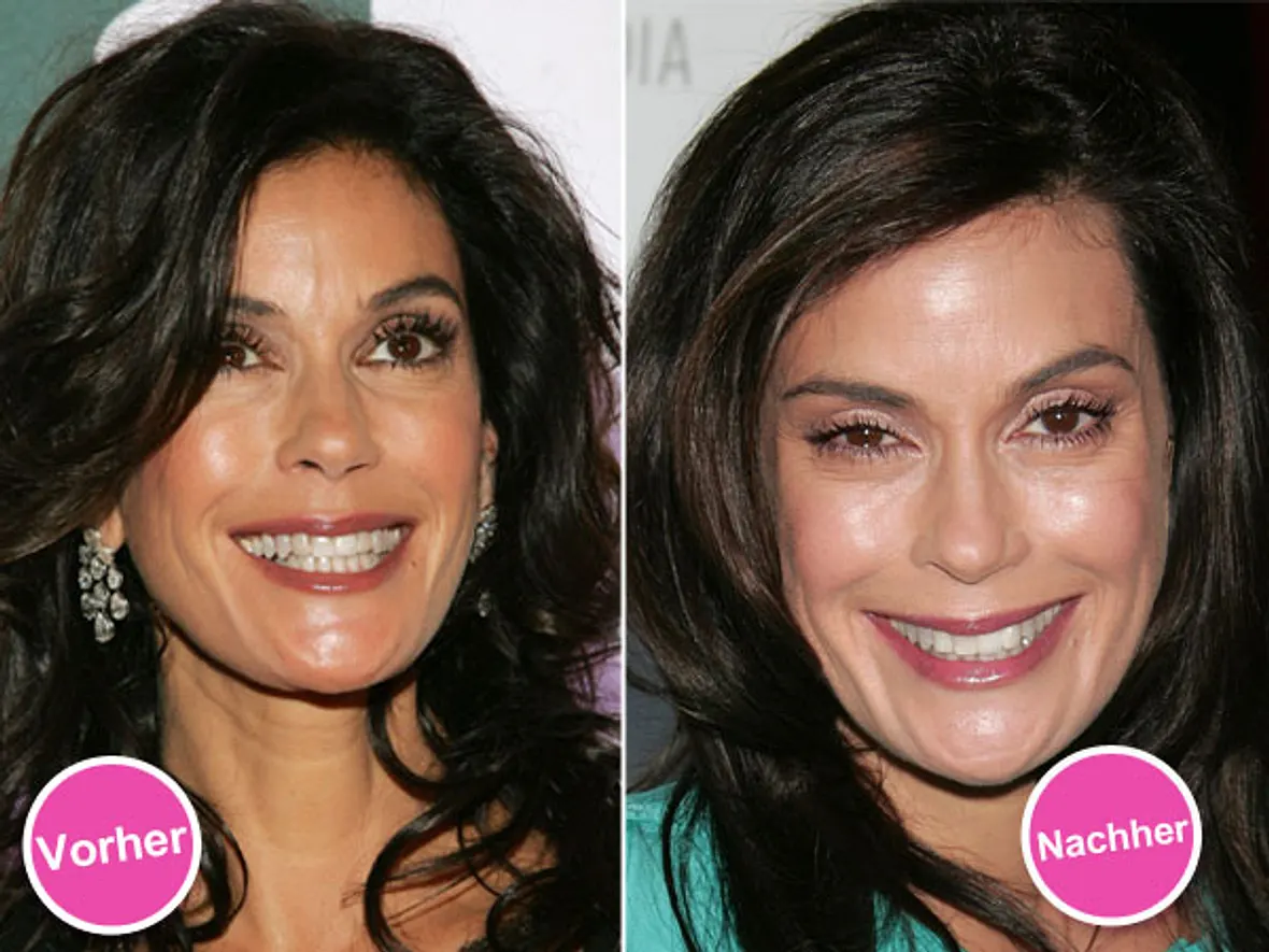 Die Beauty-Sünden der Stars: Diese Promis bereuen ihre Schönheits-OPs - Bild 4