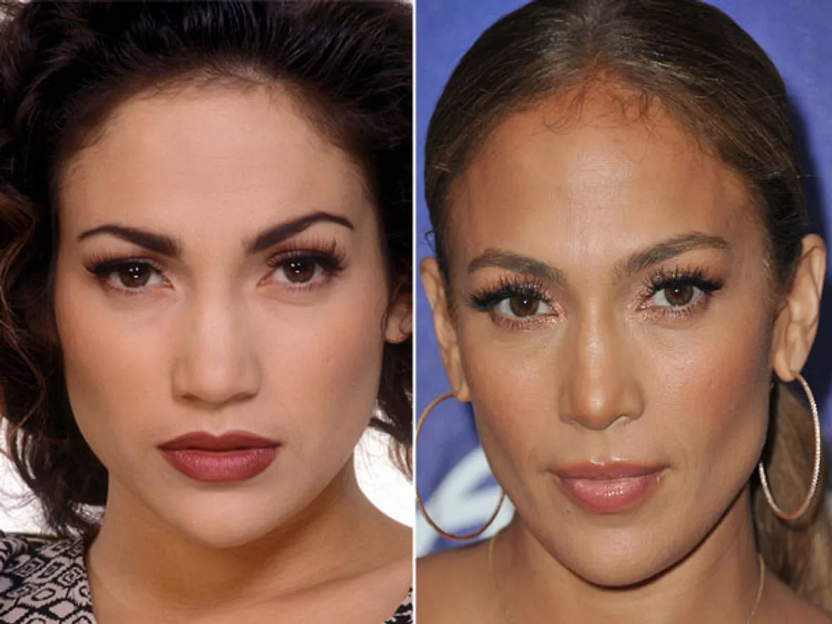 Jennifer Lopez Nasen-OP? Ja, bitte! Stars im Vorher-Nachher-Vergleich