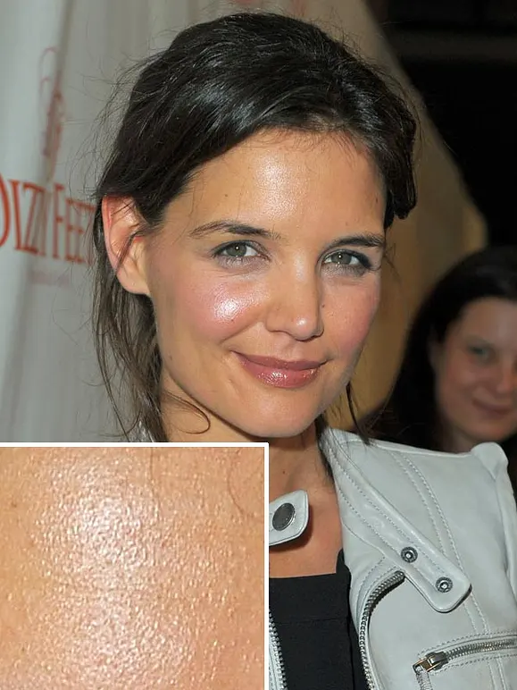 Von wegen zarter Teint! Diese Stars kämpfen mit Pickeln, Pusteln und Fettglanz - Bild 2