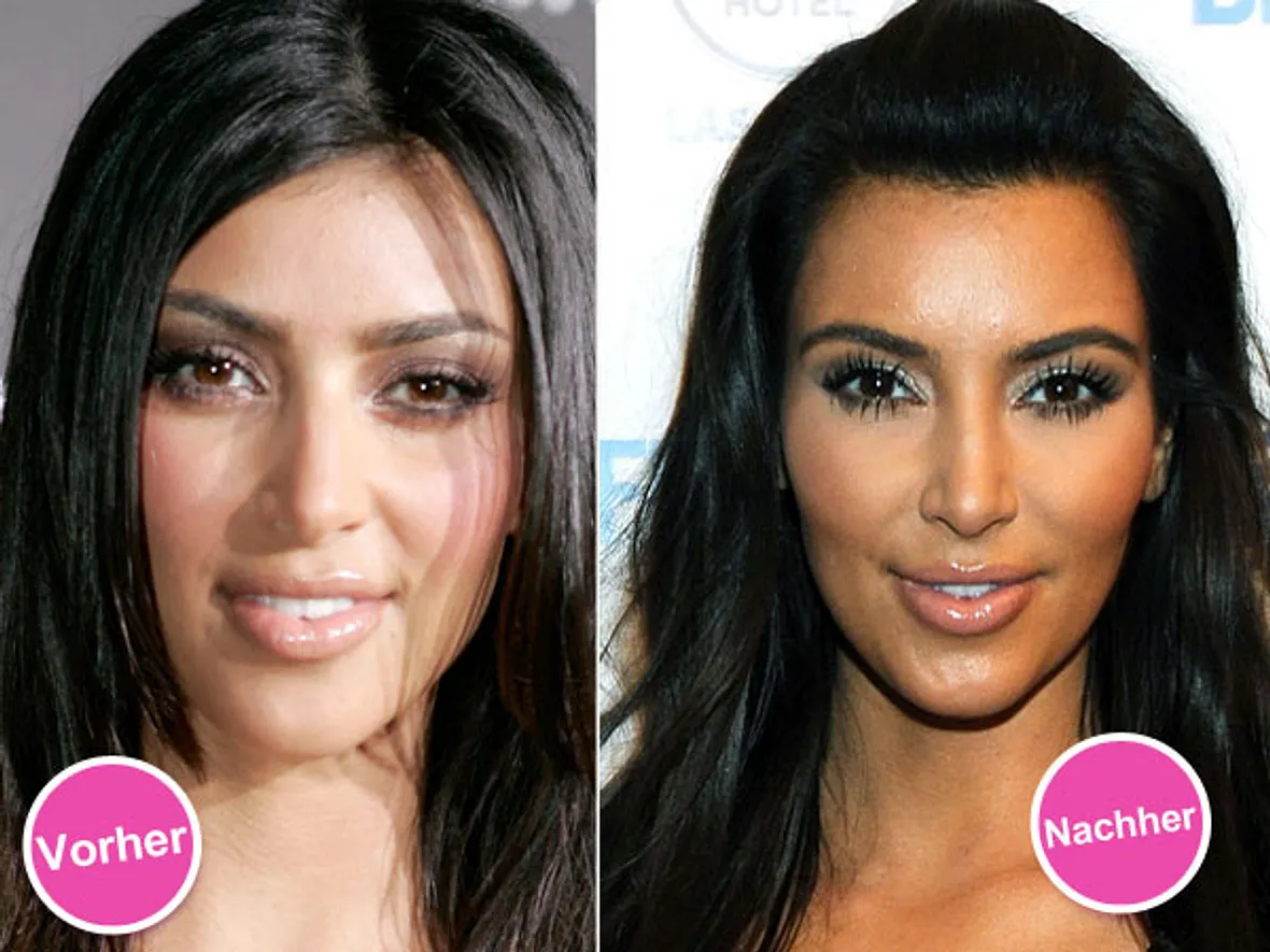 Die Beauty-Sünden der Stars: Diese Promis bereuen ihre Schönheits-OPs - Bild 6