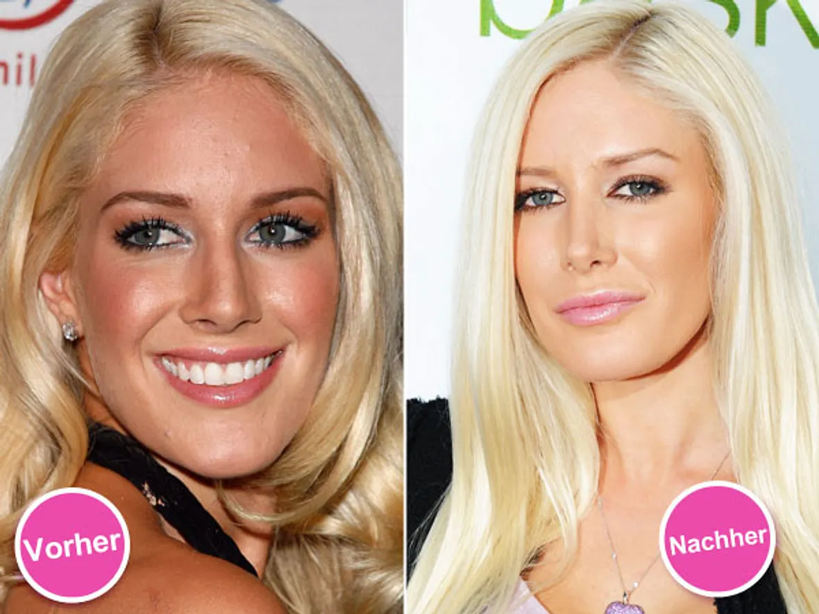 Die Beauty-Sünden der Stars: Diese Promis bereuen ihre Schönheits-OPs - Bild 2