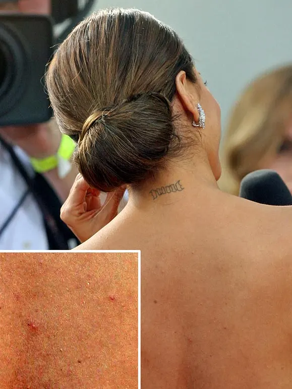 Von wegen zarter Teint! Diese Stars kämpfen mit Pickeln, Pusteln und Fettglanz - Bild 4