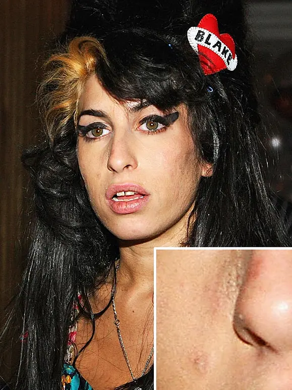 Von wegen zarter Teint! Diese Stars kämpfen mit Pickeln, Pusteln und Fettglanz - Bild 3