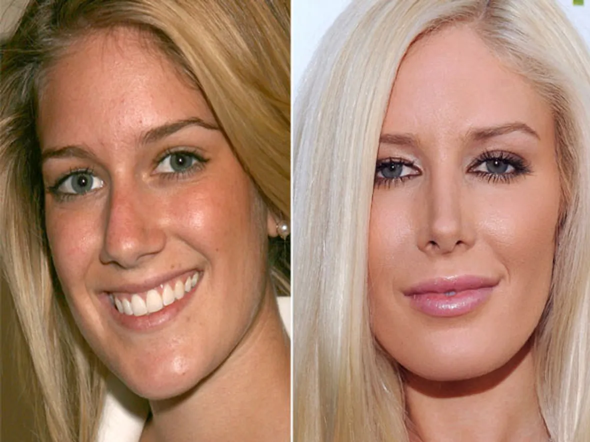Heidi Montag Nasen-OP? Ja, bitte! Stars im Vorher-Nachher-Vergleich