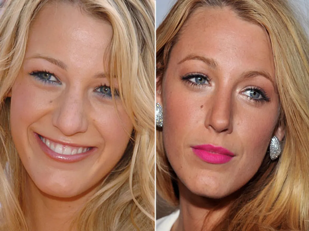 Blake Lively Nasen-OP? Ja, bitte! Stars im Vorher-Nachher-Vergleich