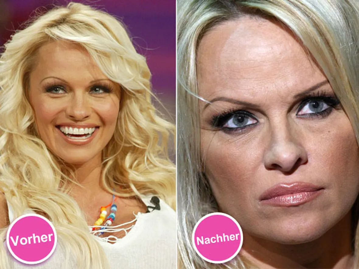 Die Beauty-Sünden der Stars: Diese Promis bereuen ihre Schönheits-OPs - Bild 9