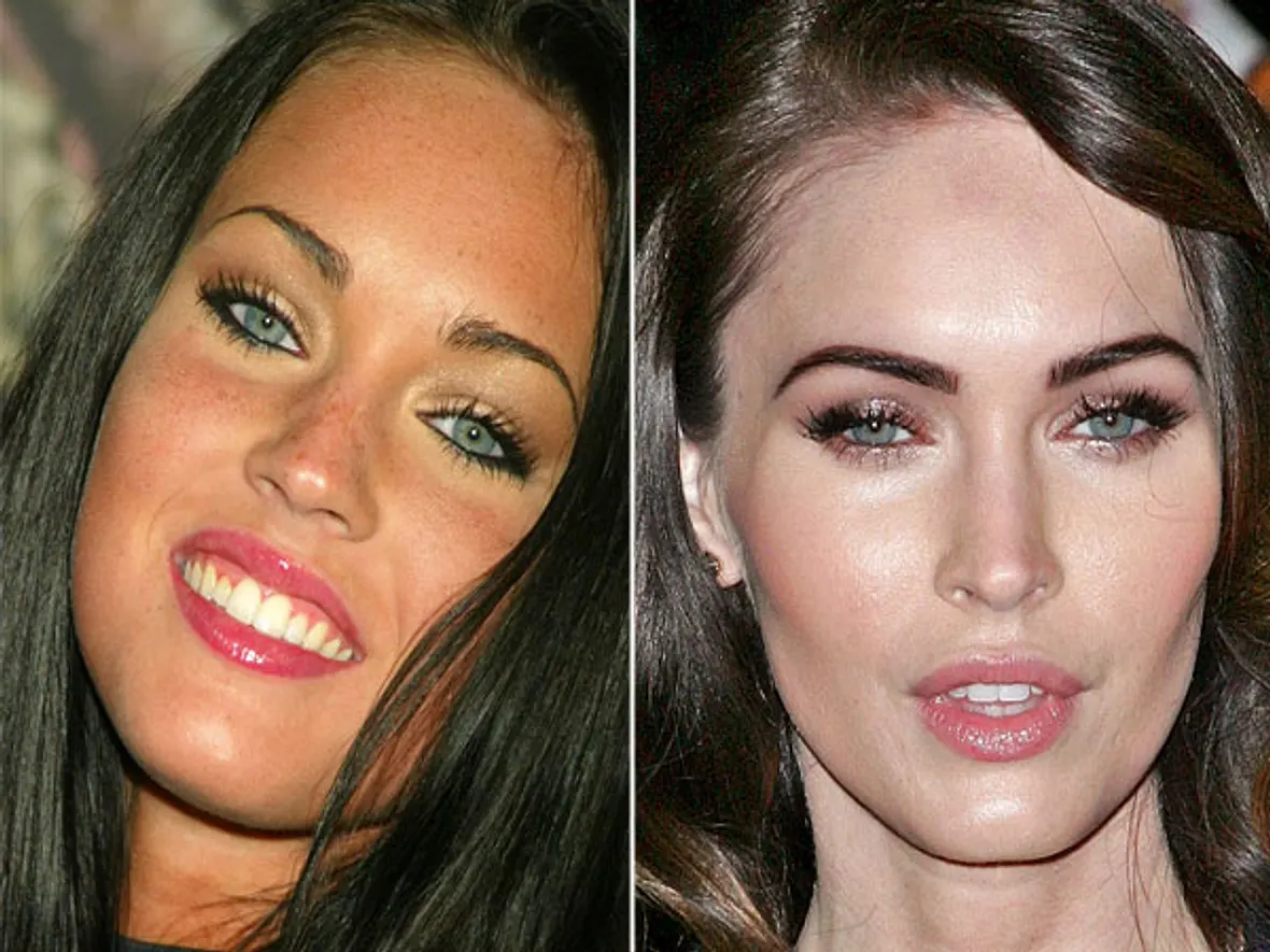 Megan Fox Nasen-OP? Ja, bitte! Stars im Vorher-Nachher-Vergleich
