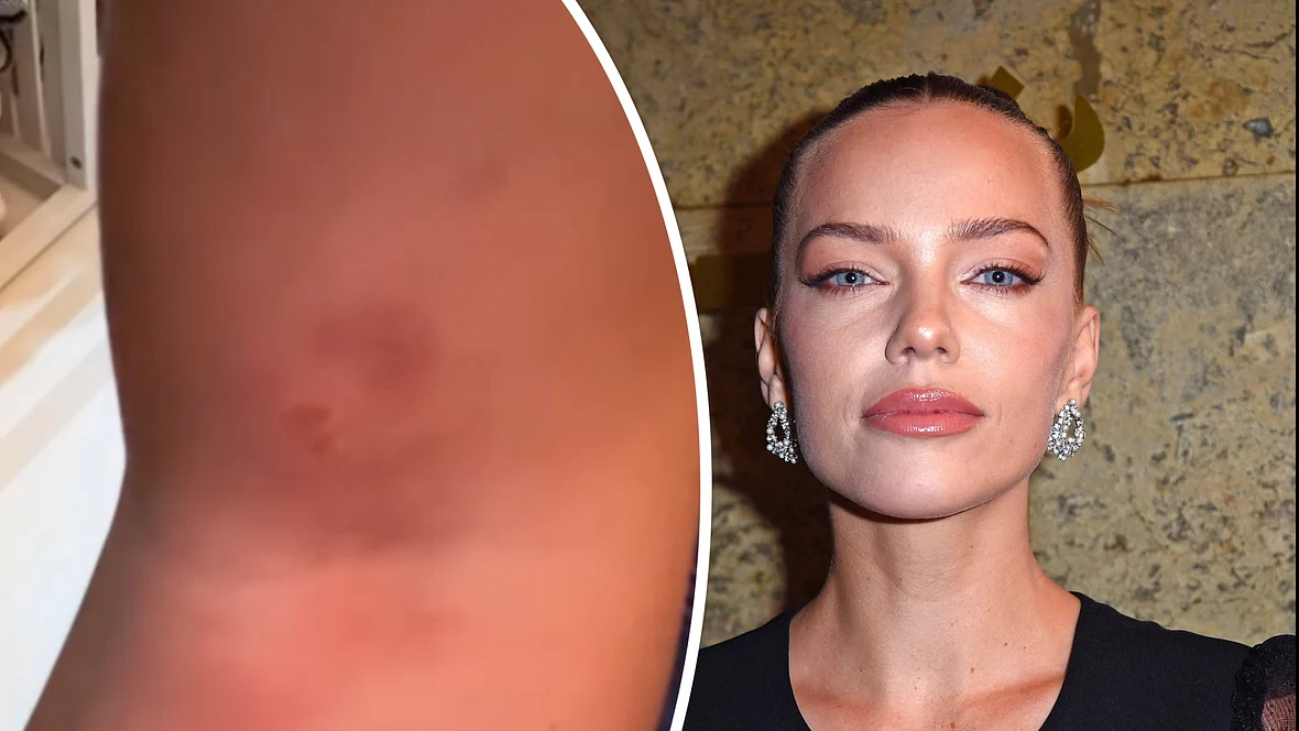 Links ein Bein voller blauer Flecken, rechts ein Foto von Laura Maria Rypa