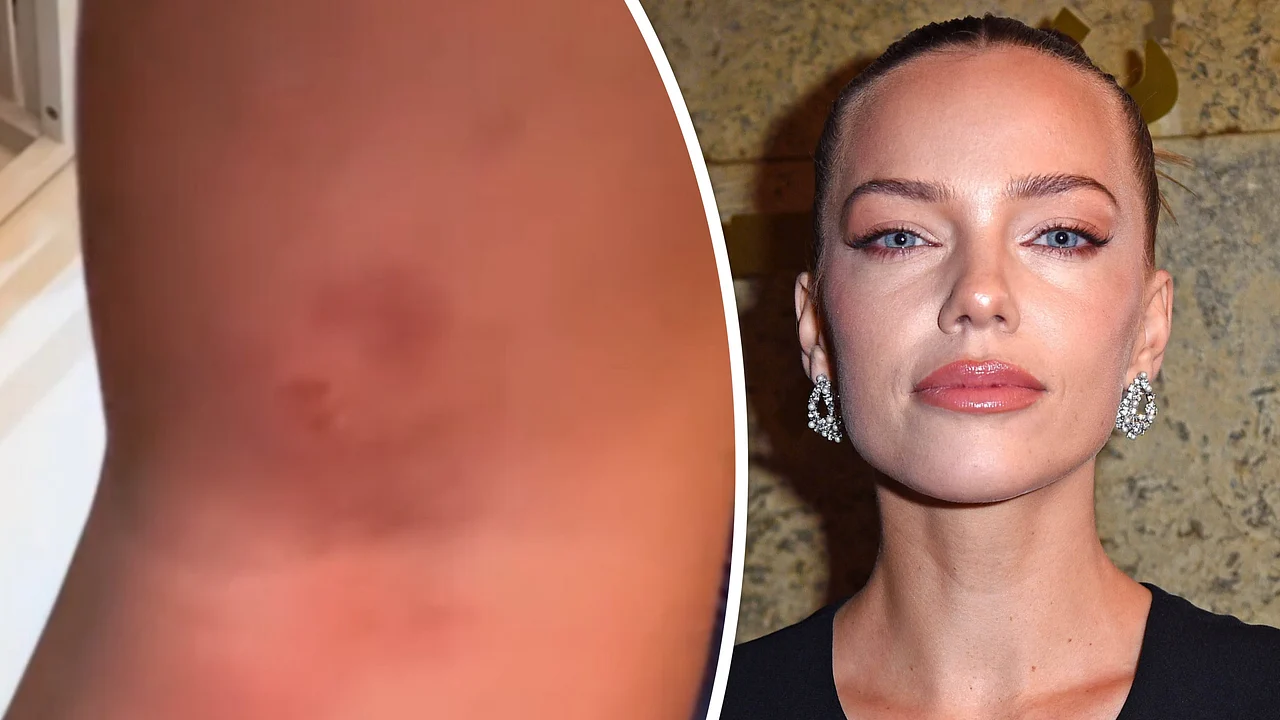 Laura Maria Rypa zeigt Blutergüsse Links ein Bein voller blauer Flecken, rechts ein Foto von Laura Maria Rypa - Foto: IMAGO / Gartner und Instagram/Laura-Maria-Rypa