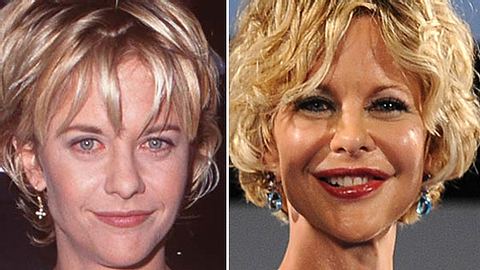 Dank Botox ist Meg Ryan kaum mehr zu erkennen - Foto: Getty images