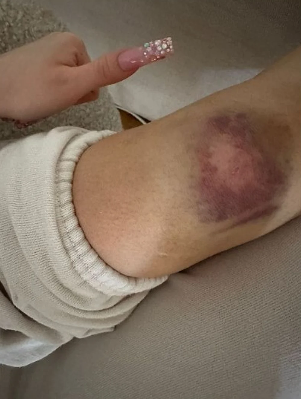 Shirin David zeigt ihr Knie Shirin David zeigt ihr Knie