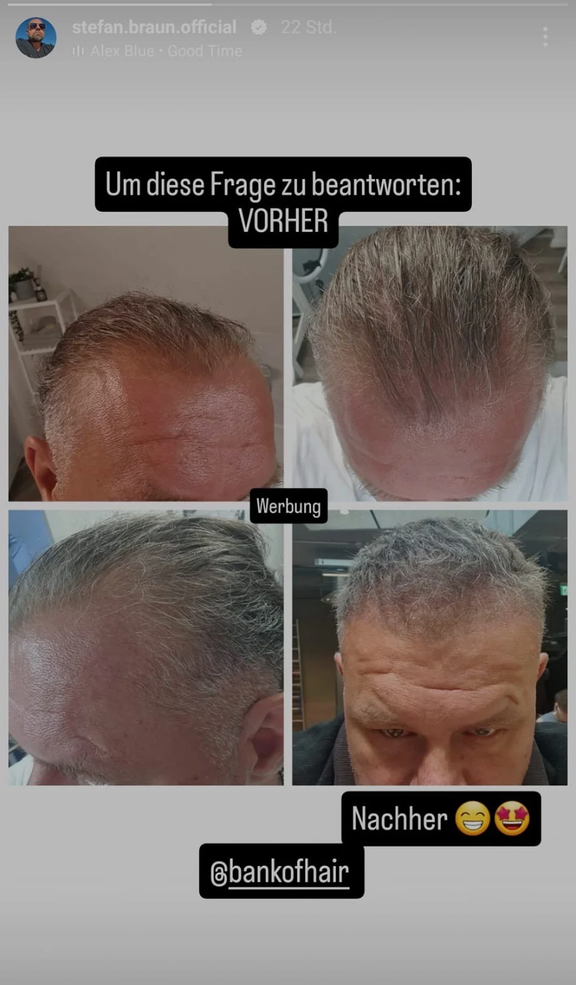 Stefan Braun Haartransplantation Stefan Braun Haartransplantation